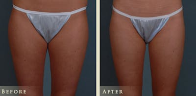 Mommy Makeover Before & After Gallery - Patient 135394 - Image 9