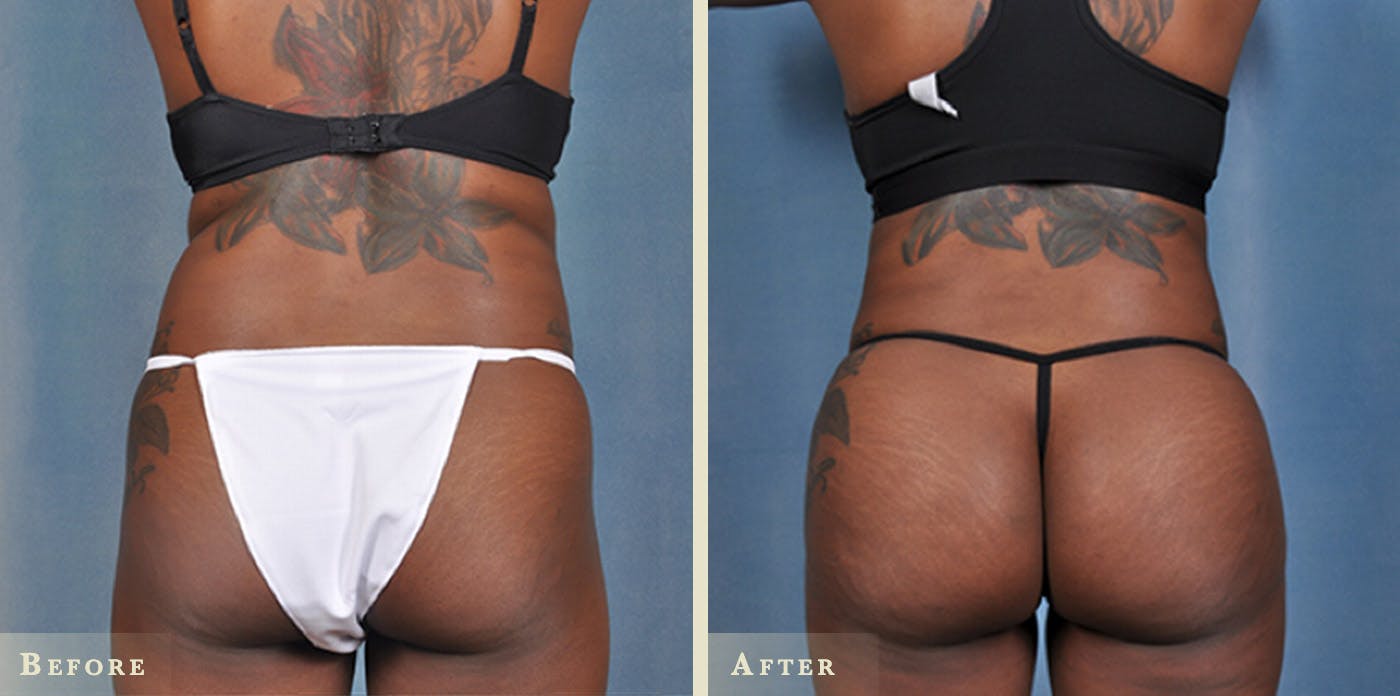 Brazilian Butt Lift Before & After Gallery - Patient 258241 - Image 1