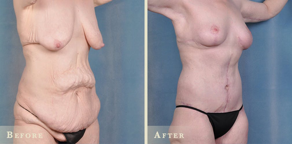 Body Lift Before & After Gallery - Patient 396803 - Image 3