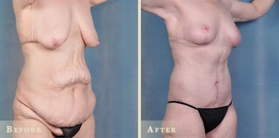 Body Lift Before & After Gallery - Patient 396803 - Image 3
