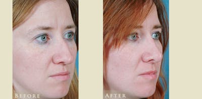 Aesthetic Rhinoplasty Before & After Gallery - Patient 271118 - Image 2
