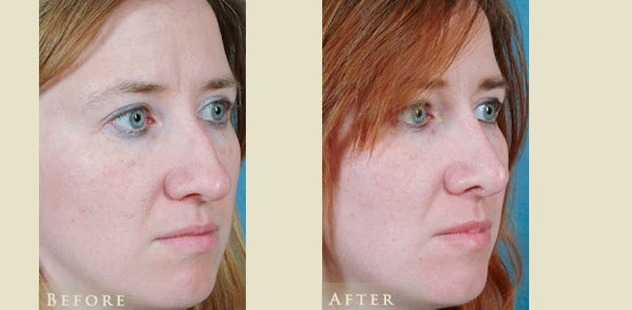 Aesthetic Rhinoplasty Before & After Gallery - Patient 271118 - Image 2