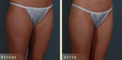 Mommy Makeover Before & After Gallery - Patient 135394 - Image 10