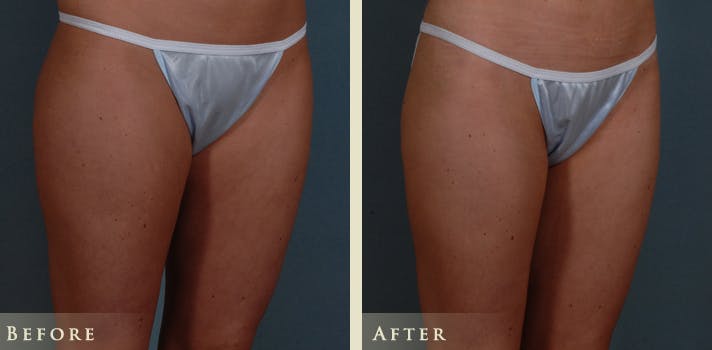 Mommy Makeover Before & After Gallery - Patient 135394 - Image 10