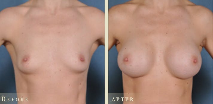 Breast Augmentation Before & After Gallery - Patient 309474 - Image 1