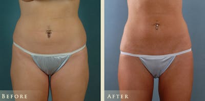 Female Liposuction Before & After Gallery - Patient 428025 - Image 1