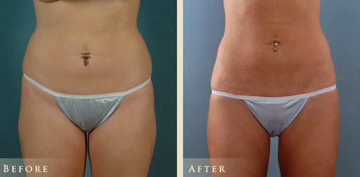 Female Liposuction Before & After Gallery - Patient 428025 - Image 1