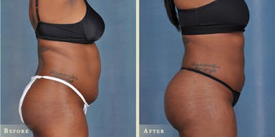 Brazilian Butt Lift Before & After Gallery - Patient 258241 - Image 2