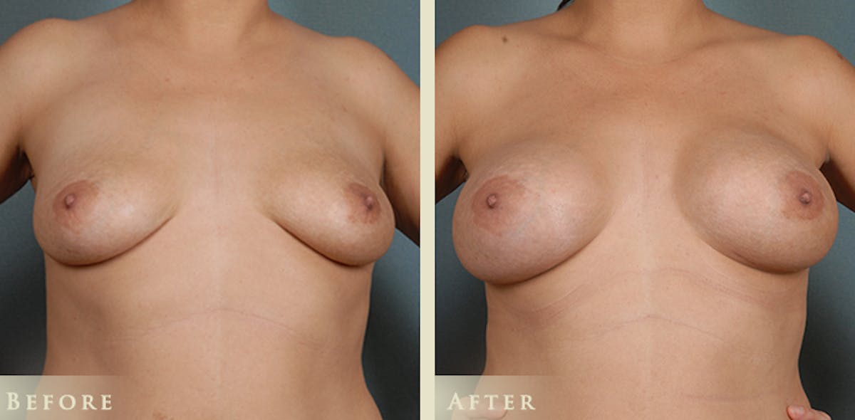 Breast Augmentation with Anatomical Silicone Implants Before & After Gallery - Patient 275687 - Image 1