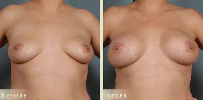 Breast Augmentation Before & After Gallery - Patient 252890 - Image 1