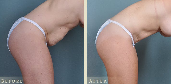 Tummy Tuck Before & After Gallery - Patient 764574 - Image 8