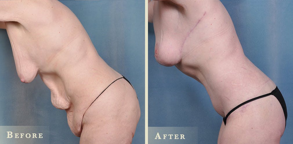 Body Lift Before & After Gallery - Patient 396803 - Image 4
