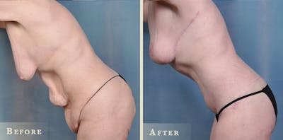 Body Lift Before & After Gallery - Patient 396803 - Image 4