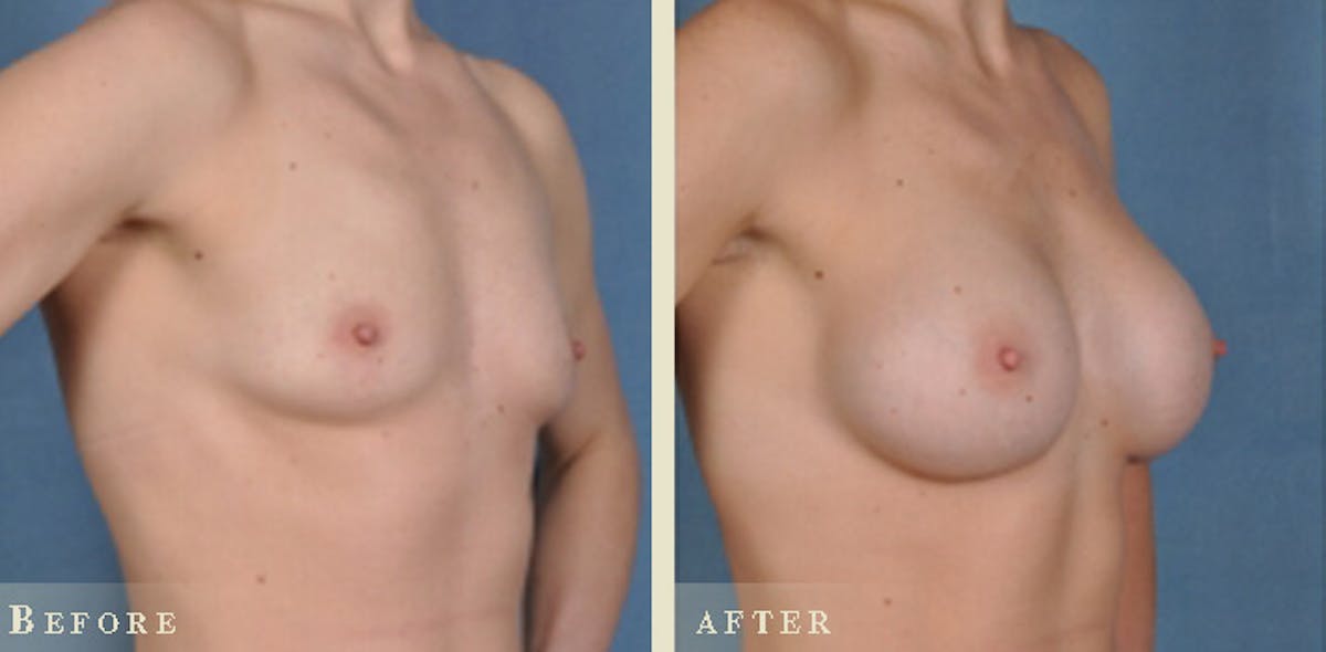 Breast Augmentation with Silicone Implants Before & After Gallery - Patient 309474 - Image 2
