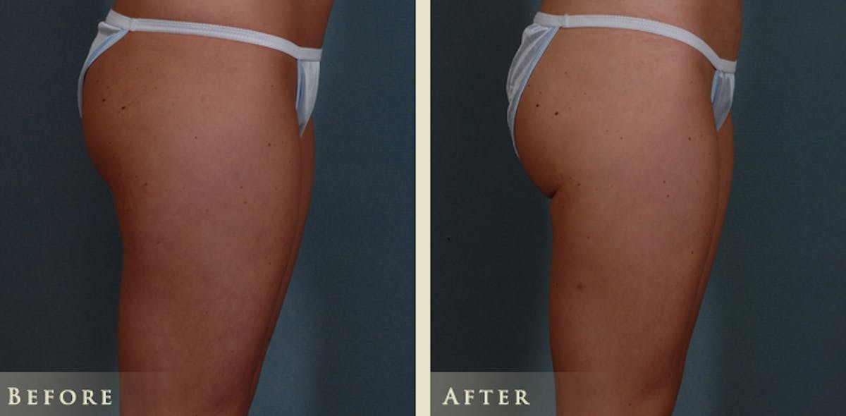 Mommy Makeover Before & After Gallery - Patient 135394 - Image 11