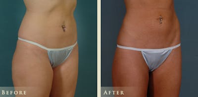 Female Liposuction Before & After Gallery - Patient 428025 - Image 2