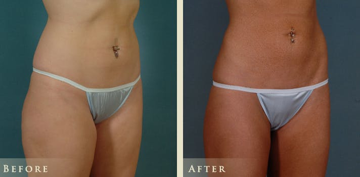 Female Liposuction Before & After Gallery - Patient 428025 - Image 2