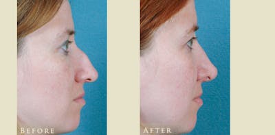 Aesthetic Rhinoplasty Before & After Gallery - Patient 271118 - Image 3