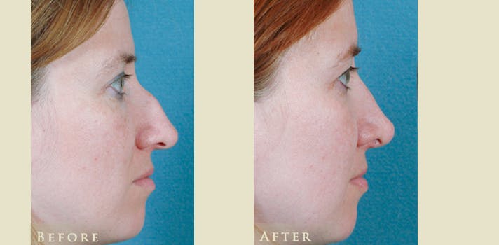 Aesthetic Rhinoplasty Before & After Gallery - Patient 271118 - Image 3