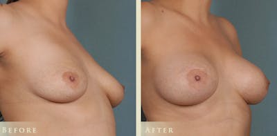 Breast Augmentation Before & After Gallery - Patient 252890 - Image 2