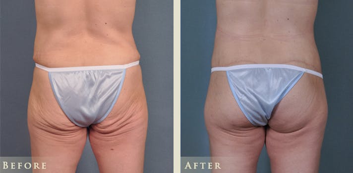 Brazilian Butt Lift Before & After Gallery - Patient 186135 - Image 1