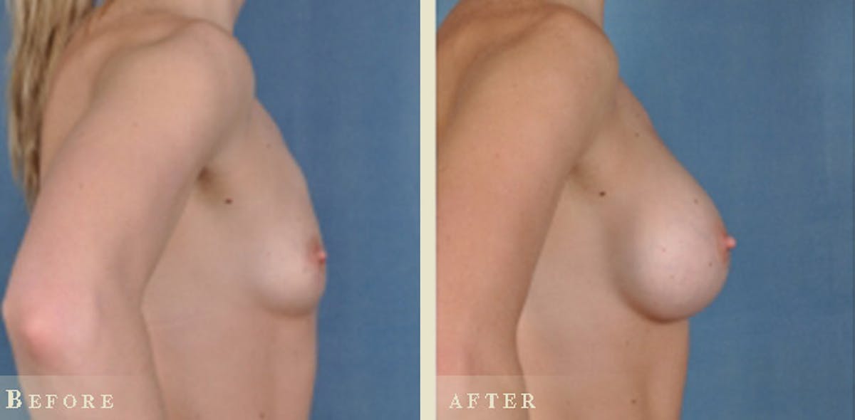 Breast Augmentation with Silicone Implants Before & After Gallery - Patient 309474 - Image 3