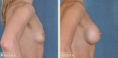 Breast Augmentation Before & After Gallery - Patient 309474 - Image 3