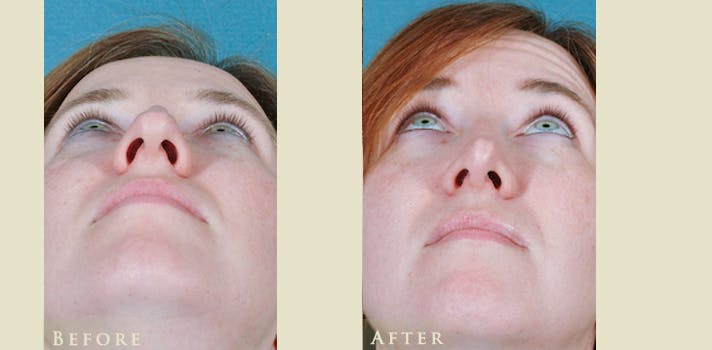 Aesthetic Rhinoplasty Before & After Gallery - Patient 271118 - Image 4