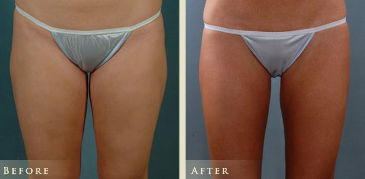 Female Liposuction Before & After Gallery - Patient 428025 - Image 3