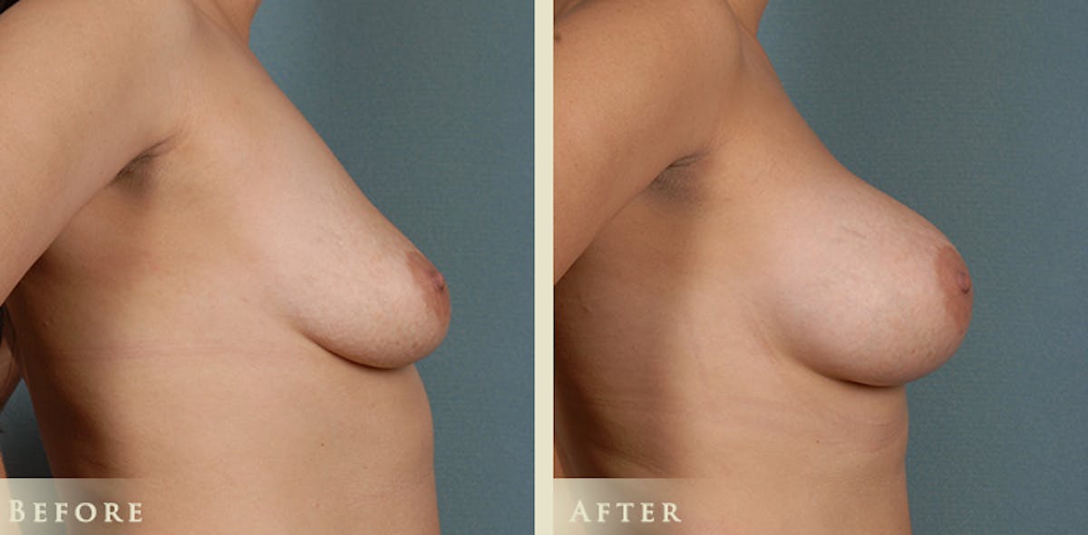 Breast Augmentation with Anatomical Silicone Implants Before & After Gallery - Patient 275687 - Image 3