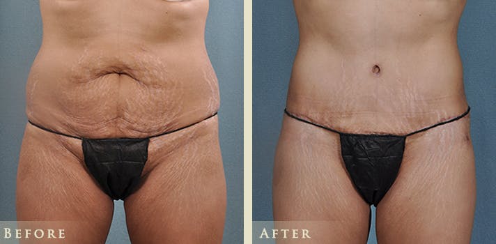 Tummy Tuck Before & After Gallery - Patient 121832 - Image 1
