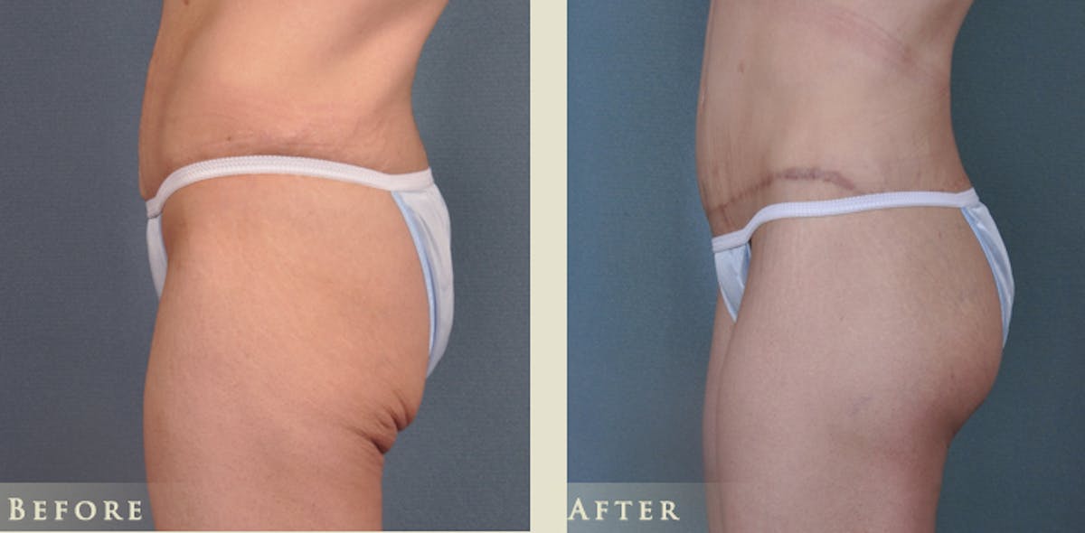 Brazilian Butt Lift Before & After Gallery - Patient 186135 - Image 2