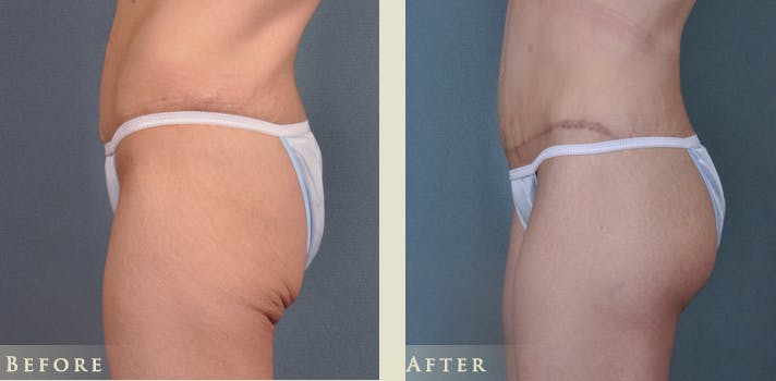Brazilian Butt Lift Before & After Gallery - Patient 186135 - Image 2