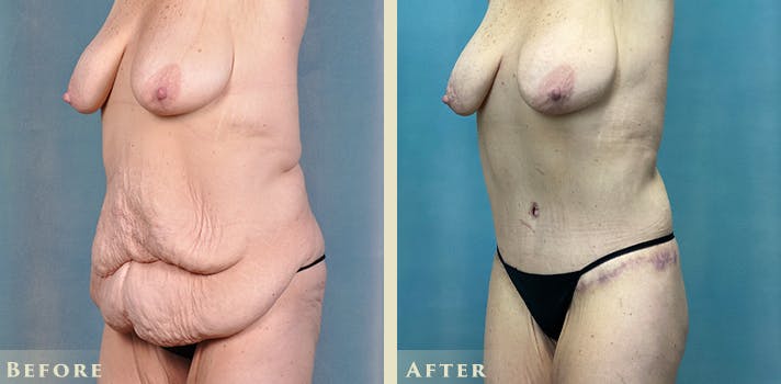 Body Lift Before & After Gallery - Patient 182955 - Image 2