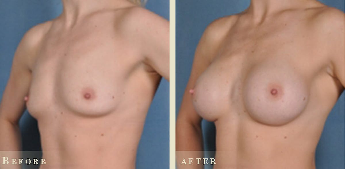 Breast Augmentation with Silicone Implants Before & After Gallery - Patient 309474 - Image 4