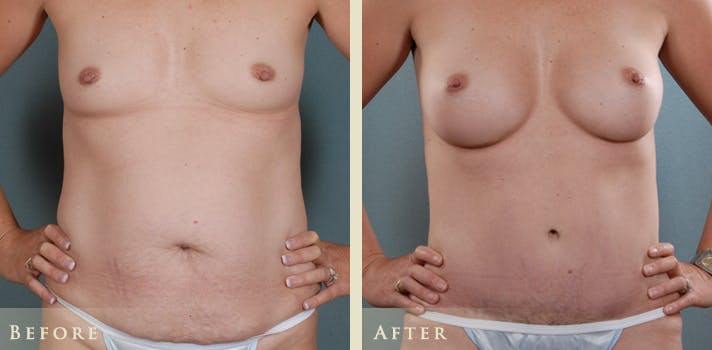 Mommy Makeover Before & After Gallery - Patient 191043 - Image 1