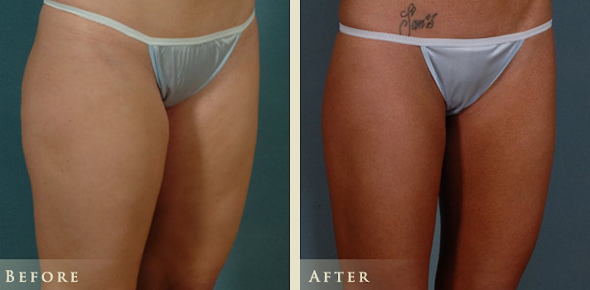 Female Liposuction Before & After Gallery - Patient 428025 - Image 4
