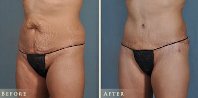 Tummy Tuck Before & After Gallery - Patient 121832 - Image 2