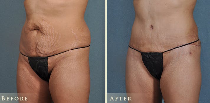 Tummy Tuck Before & After Gallery - Patient 121832 - Image 2