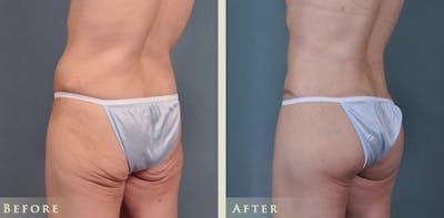 Brazilian Butt Lift Before & After Gallery - Patient 186135 - Image 3