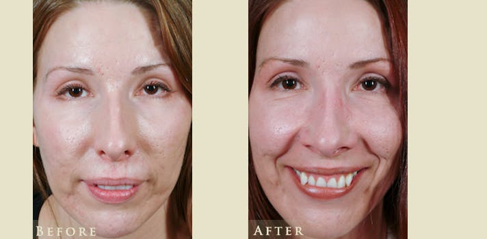 Aesthetic Rhinoplasty Before & After Gallery - Patient 143704 - Image 1