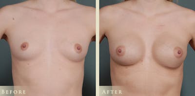 Breast Augmentation Before & After Gallery - Patient 256033 - Image 1