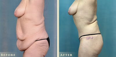 Body Lift Before & After Gallery - Patient 182955 - Image 3