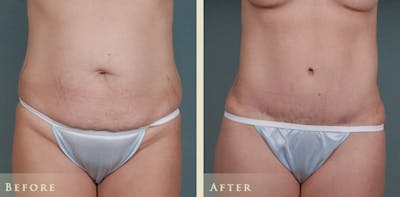 Mommy Makeover Before & After Gallery - Patient 191043 - Image 2