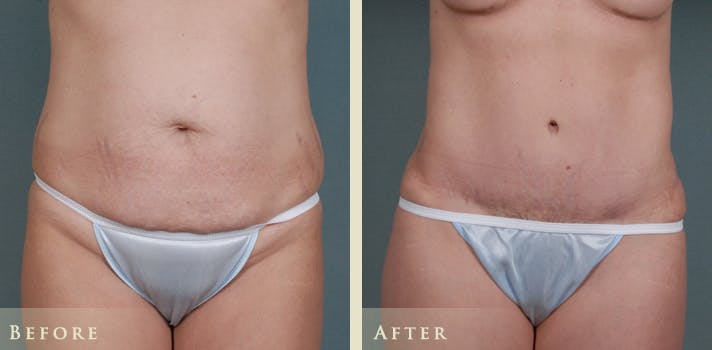 Mommy Makeover Before & After Gallery - Patient 191043 - Image 2