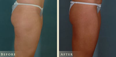 Female Liposuction Before & After Gallery - Patient 428025 - Image 5