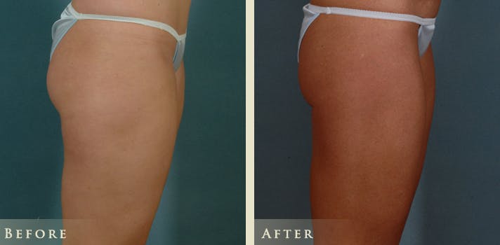Female Liposuction Before & After Gallery - Patient 428025 - Image 5