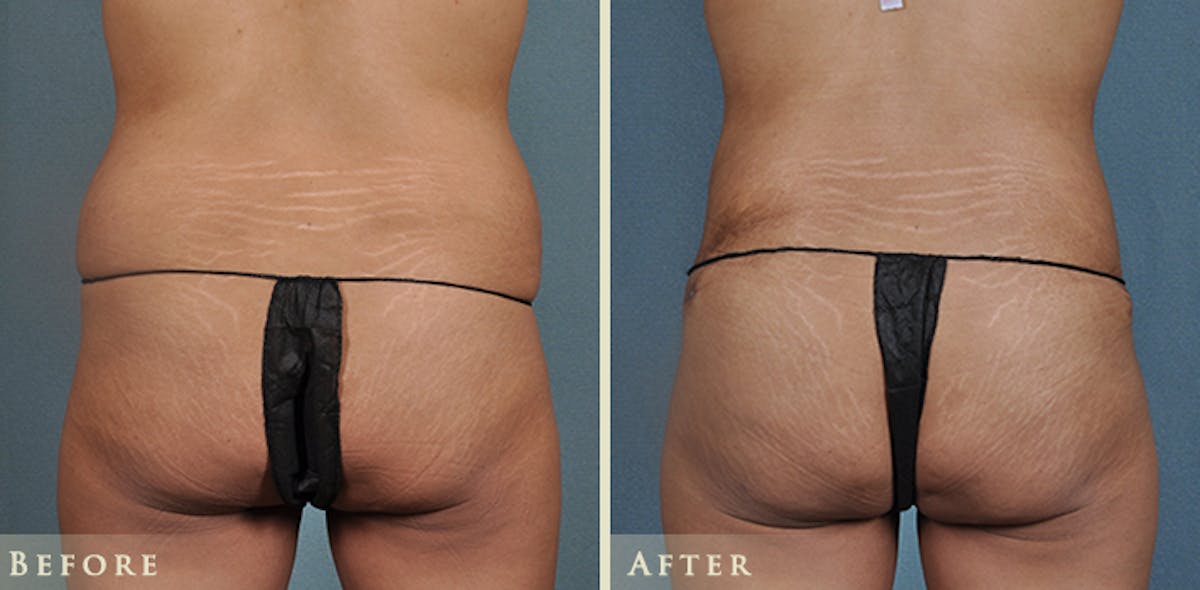 Tummy Tuck Before & After Gallery - Patient 121832 - Image 3