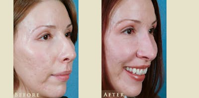 Aesthetic Rhinoplasty Before & After Gallery - Patient 143704 - Image 2