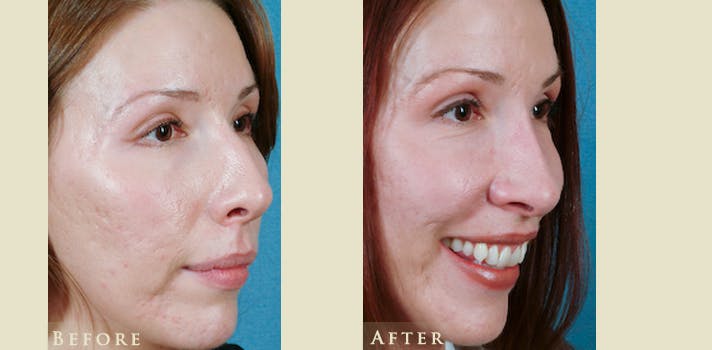 Aesthetic Rhinoplasty Before & After Gallery - Patient 143704 - Image 2